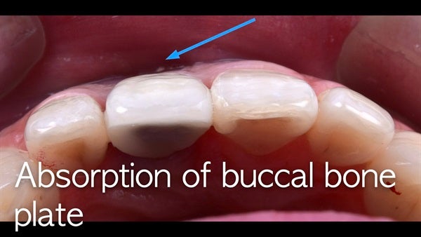 The   One-Time   Socket   Abutment Just    For   Incisor