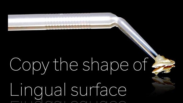 The Immediately  restoration of Central Incisor  on Lingual  Surface 