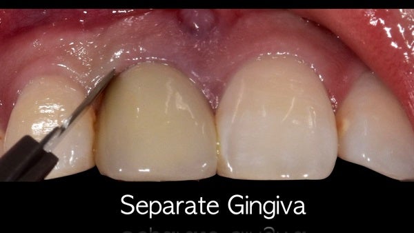 The   One-Time   Socket   Abutment Just    For   Incisor