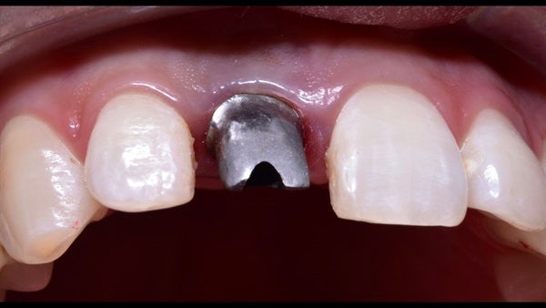 The   One-Time   Socket   Abutment Just    For   Incisor