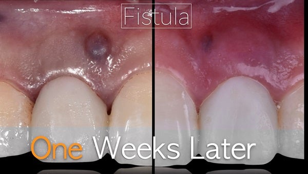 The   One-Time   Socket   Abutment Just    For   Incisor