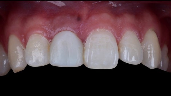 The   One-Time   Socket   Abutment Just    For   Incisor
