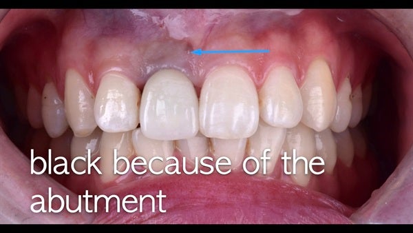 The   One-Time   Socket   Abutment Just    For   Incisor