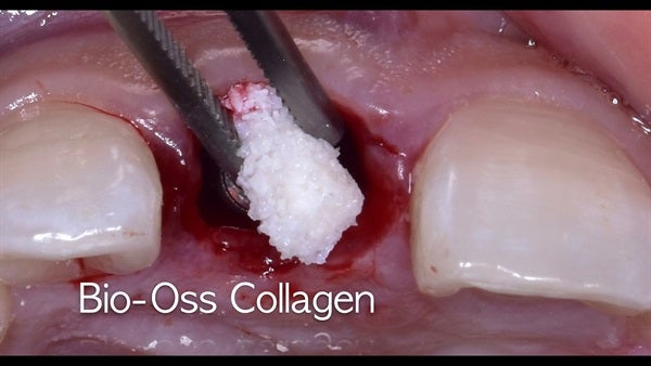 The   One-Time   Socket   Abutment Just    For   Incisor