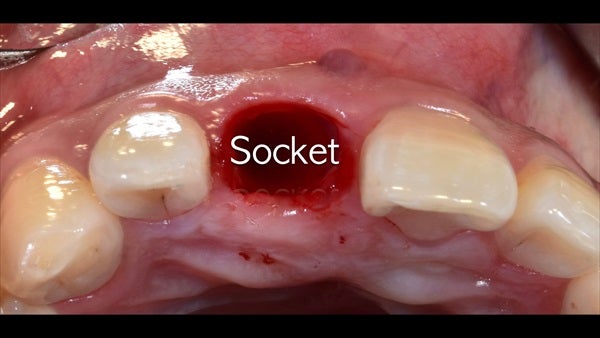 The   One-Time   Socket   Abutment Just    For   Incisor