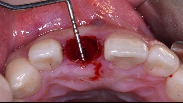 The   One-Time   Socket   Abutment Just    For   Incisor