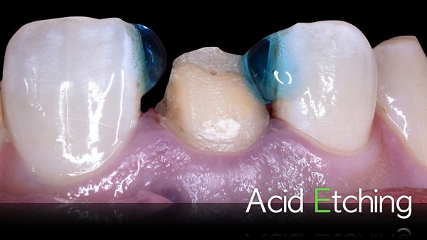 The   One-Time   Socket   Abutment Just    For   Incisor