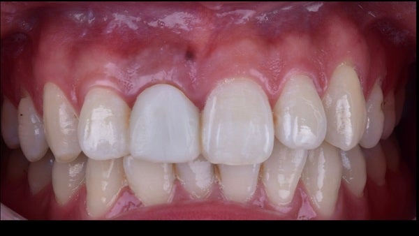 The   One-Time   Socket   Abutment Just    For   Incisor