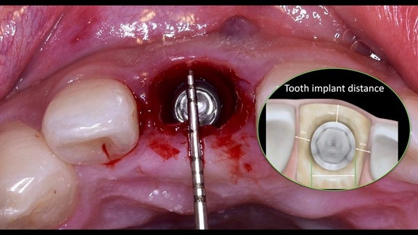 The   One-Time   Socket   Abutment Just    For   Incisor