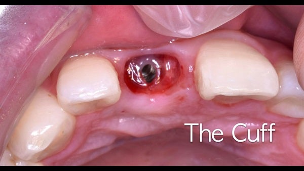 The   One-Time   Socket   Abutment Just    For   Incisor