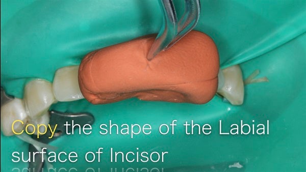 Icon Resin Removes Chalky Plaque