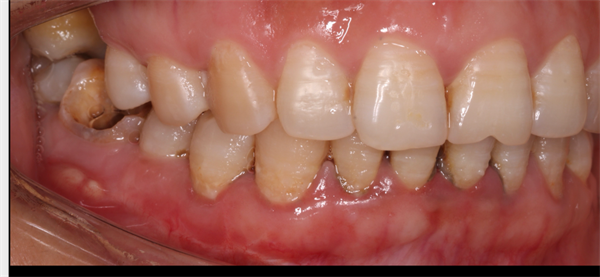 The Rct for big cyst