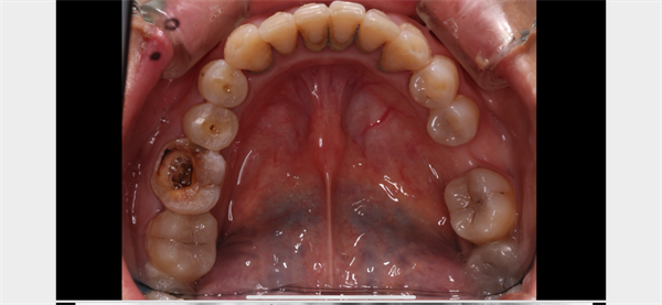 The Rct for big cyst