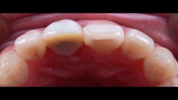 The   One-Time   Socket   Abutment Just    For   Incisor