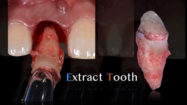 The   One-Time   Socket   Abutment Just    For   Incisor