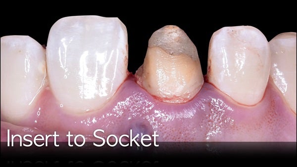 The   One-Time   Socket   Abutment Just    For   Incisor