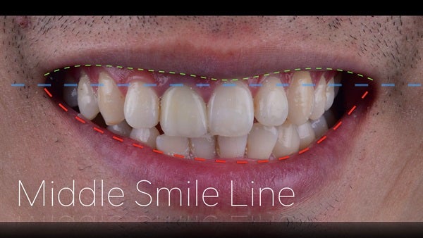 The   One-Time   Socket   Abutment Just    For   Incisor