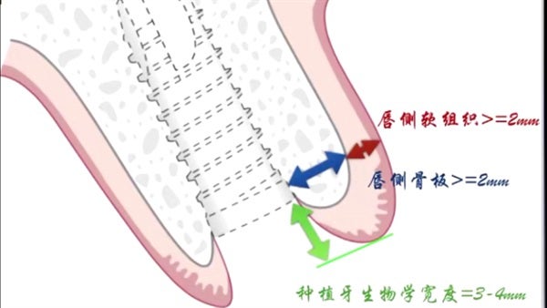 The   One-Time   Socket   Abutment Just    For   Incisor