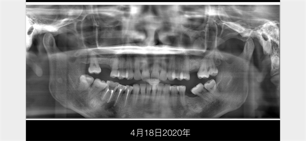 The Rct for big cyst