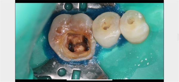The Rct for big cyst