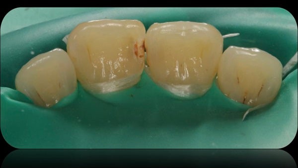 The Immediately  restoration of Central Incisor  on Lingual  Surface 
