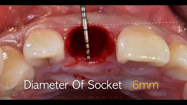 The   One-Time   Socket   Abutment Just    For   Incisor