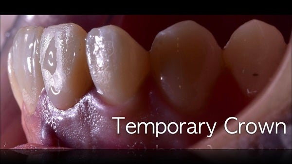 The   One-Time   Socket   Abutment Just    For   Incisor