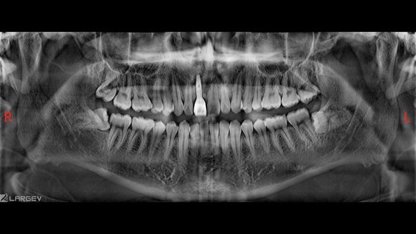 The   One-Time   Socket   Abutment Just    For   Incisor