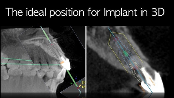 The   One-Time   Socket   Abutment Just    For   Incisor