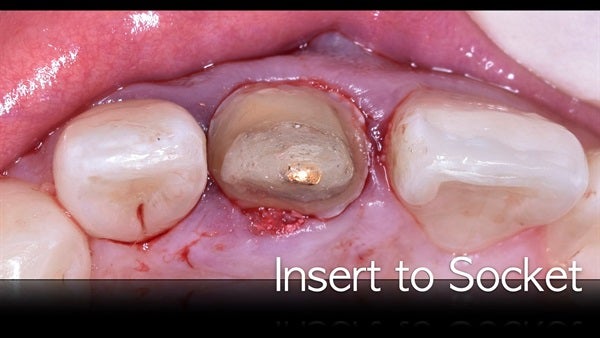 The   One-Time   Socket   Abutment Just    For   Incisor