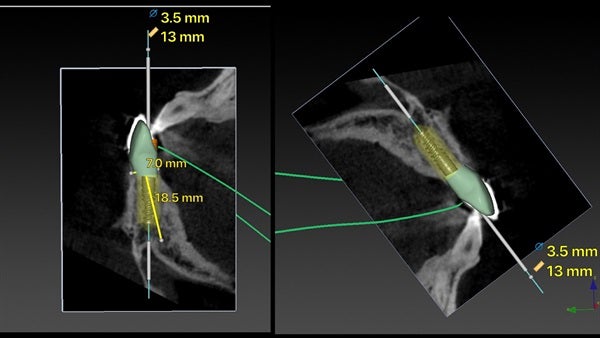 The   One-Time   Socket   Abutment Just    For   Incisor