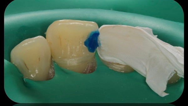 The Immediately  restoration of Central Incisor  on Lingual  Surface 