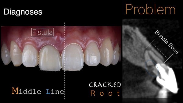 The   One-Time   Socket   Abutment Just    For   Incisor