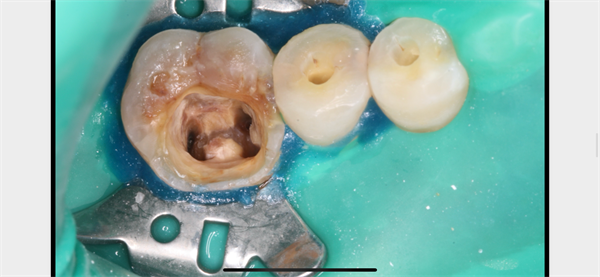 The Rct for big cyst