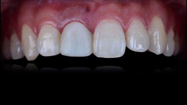 The   One-Time   Socket   Abutment Just    For   Incisor