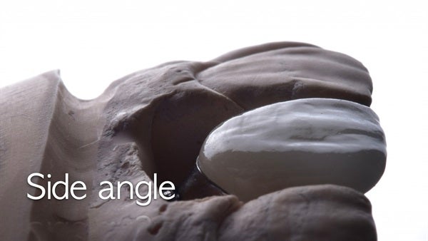 The   One-Time   Socket   Abutment Just    For   Incisor