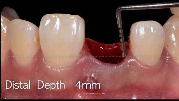 The   One-Time   Socket   Abutment Just    For   Incisor