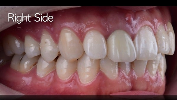 The   One-Time   Socket   Abutment Just    For   Incisor