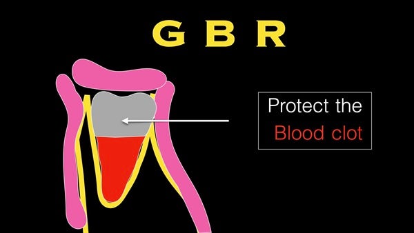 The   One-Time   Socket   Abutment Just    For   Incisor