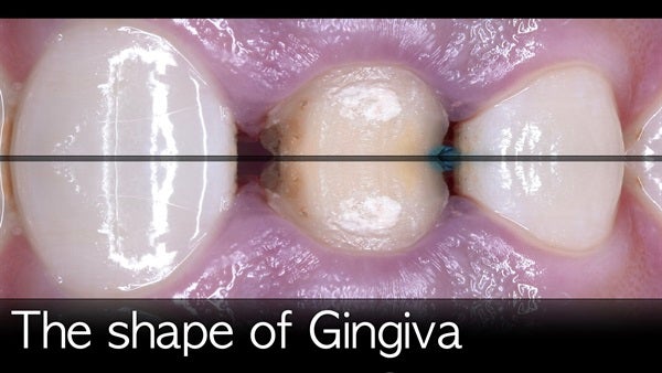 The   One-Time   Socket   Abutment Just    For   Incisor