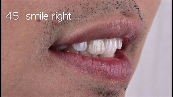 The   One-Time   Socket   Abutment Just    For   Incisor
