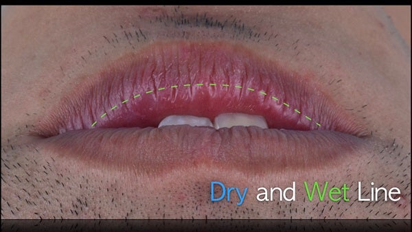 The   One-Time   Socket   Abutment Just    For   Incisor