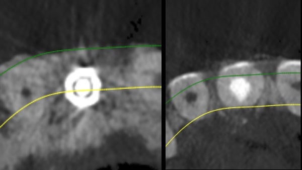 The   One-Time   Socket   Abutment Just    For   Incisor