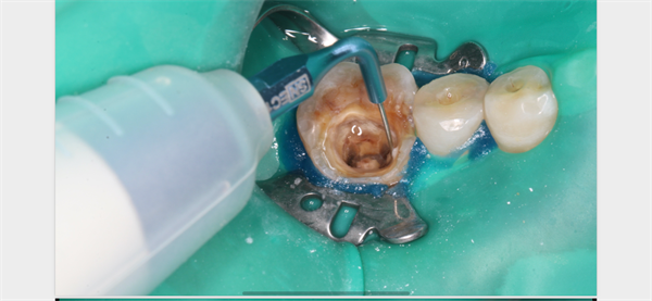 The Rct for big cyst