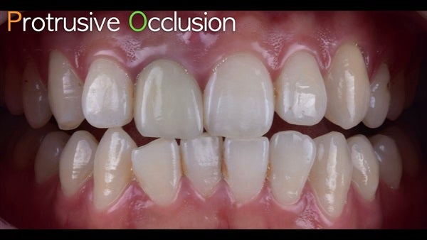 The   One-Time   Socket   Abutment Just    For   Incisor