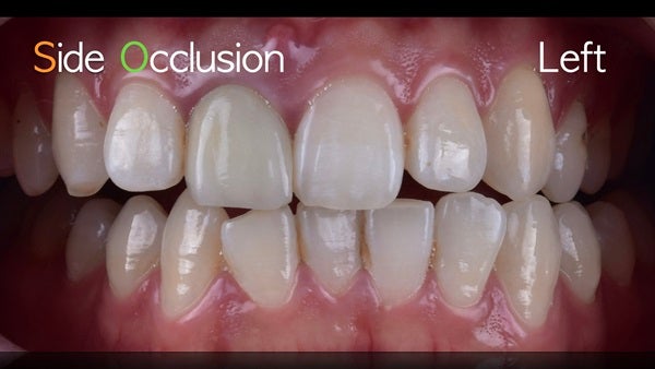 The   One-Time   Socket   Abutment Just    For   Incisor