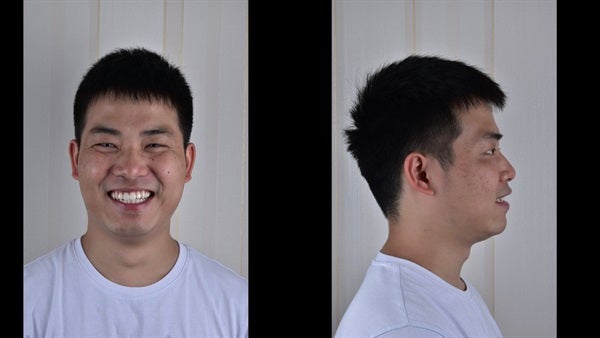 The   One-Time   Socket   Abutment Just    For   Incisor