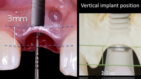 The   One-Time   Socket   Abutment Just    For   Incisor