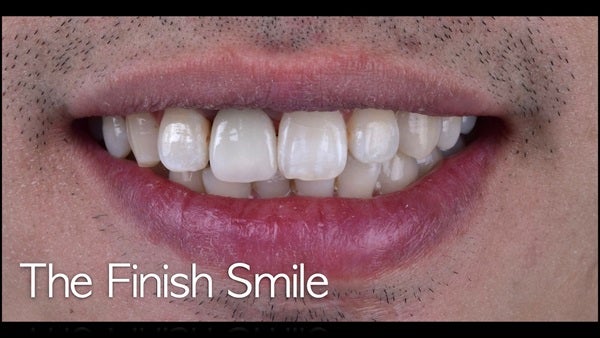 The   One-Time   Socket   Abutment Just    For   Incisor