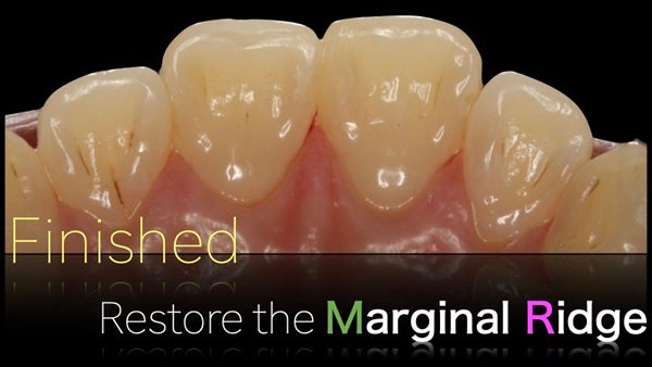 The Immediately  restoration of Central Incisor  on Lingual  Surface 